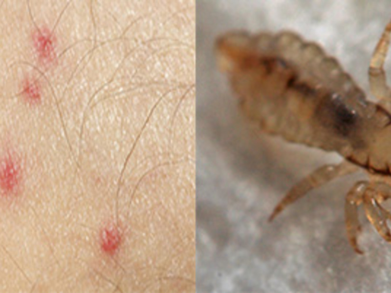 Как кусаются бельевые вши