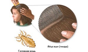 Боремся с педикулезом