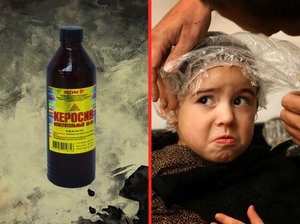 Как лечат вшей подручными средствами